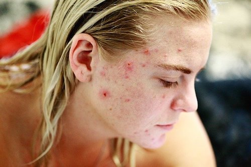 Ayurvedic Tips for Pimples , Acne and Dark Spots