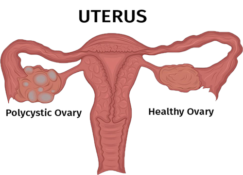 Ayurvedic Treatment for PCOS or PCOD ( polycystic ovary syndrome )