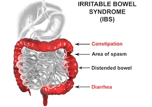 ayurvedic remedies for IBS